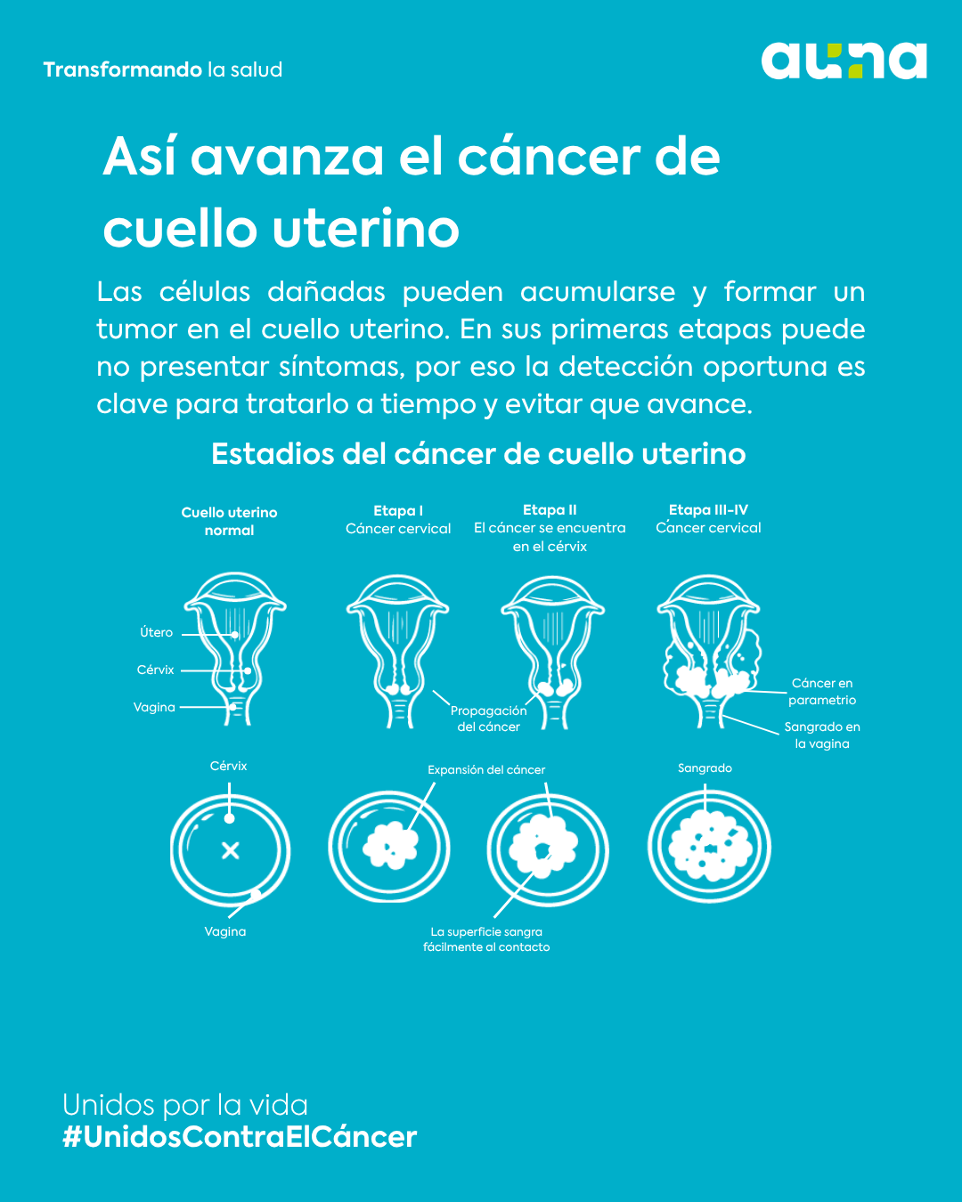 Día Mundial del Cáncer de Cuello Uterino: prevenir puede hacer la&nbsp;diferencia