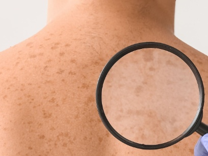 En México se registraron 2.198 nuevos casos de melanoma de piel y 833 muertes por esta&nbsp;enfermedad